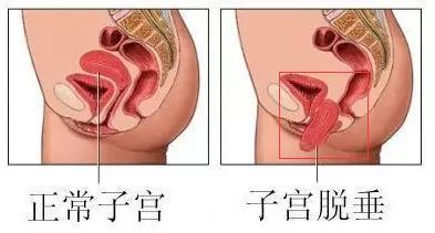 如何在产后1个月迅速恢复紧致？